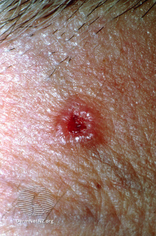 rolled edge nodular bcc skin cancer