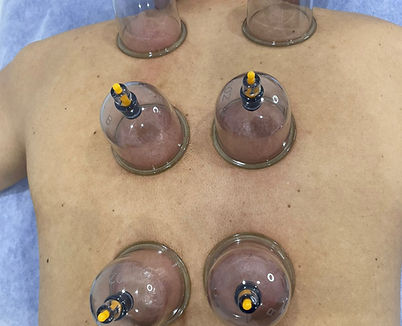 Dry cupping