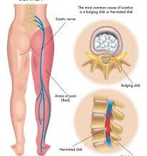 Sciatica