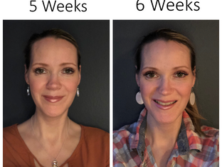 My Double Jaw Surgery: The 5th and 6th Weeks After
