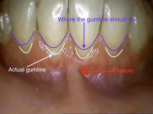 My Double Jaw Surgery: The 7th and 8th Weeks After Surgery