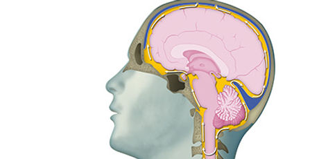 normal-pressure-hydrocephalus-teaserimag