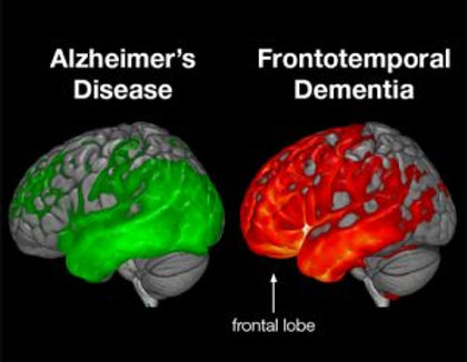 frontotemporal dementia images.jpg