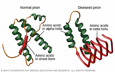 creutzfeldt-jakob disease image.webp