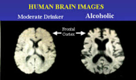 korsakoff syndrome image.jpg