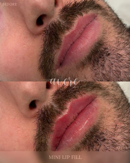 Mini Lip Fill at Avere Beauty