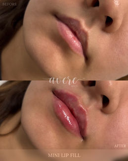 Avere Beauty Lip Filler