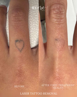Tattoo Removal at Avere Beauty