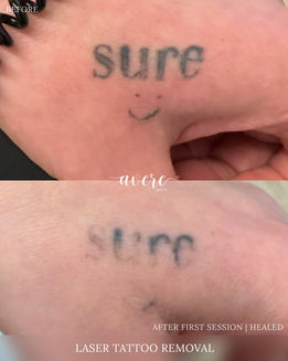Laser Tattoo Removal at Avere Beauty