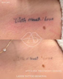 Laser Tattoo Removal at Avere Beauty