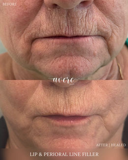 Perioral Line Filler at Avere Beauty