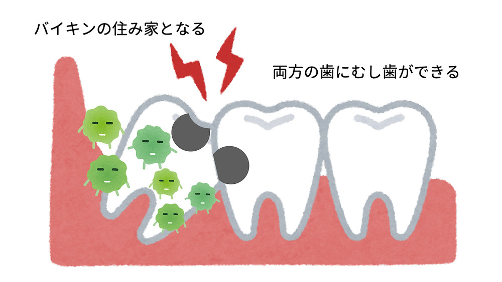 親知らずがむし歯になると起こる痛み