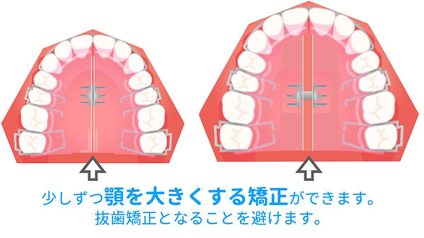 矯正用拡大床.jpeg