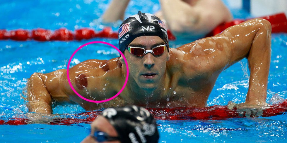 Michael Phelps. His cupping marks clearly visible.