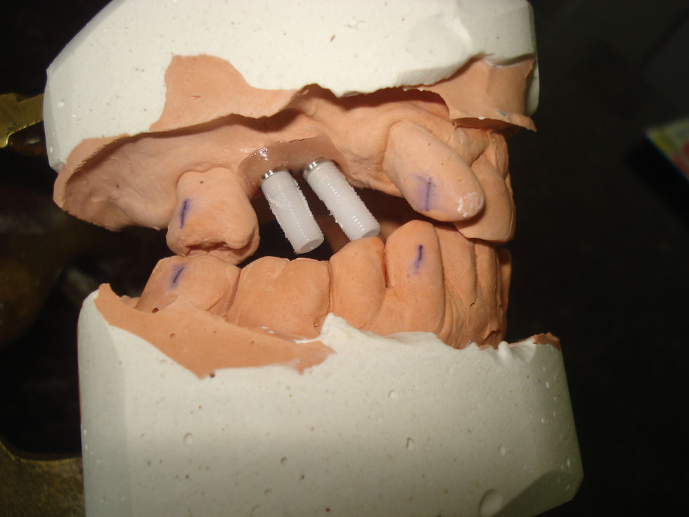 Fixa sobre implantes Sup.