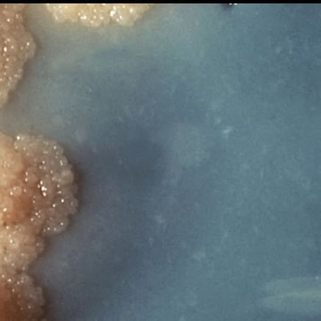 "Numa forma de tuberculose difícil de tratar, uma terapêutica mais curta e menos agressiva revela benefícios desiguais"