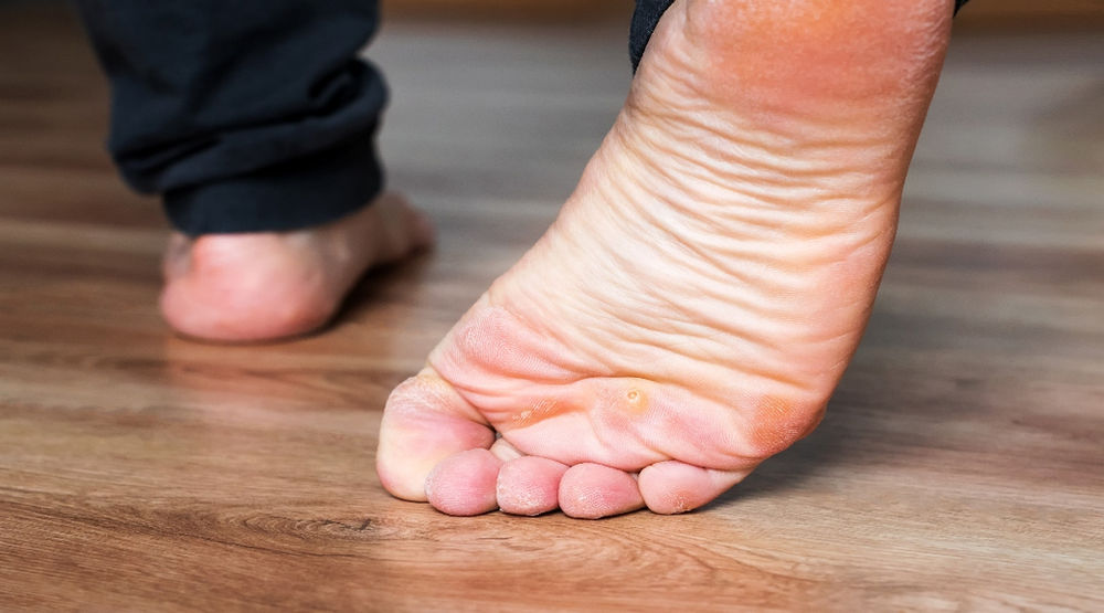 Understanding Plantar Warts