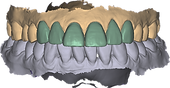 veneer.png