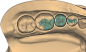 Inlay onlay02.png