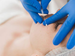 Top Benefits of Choosing a Thread Face Lift