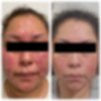 Woman with Rosacea - Before & After Treatment