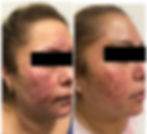 Woman with Rosacea - Before & After Treatment