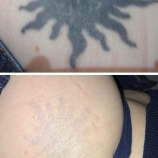 Before and after tattoo removal