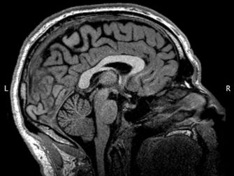 Talking Brains: The unfamiliar grey matter(s)