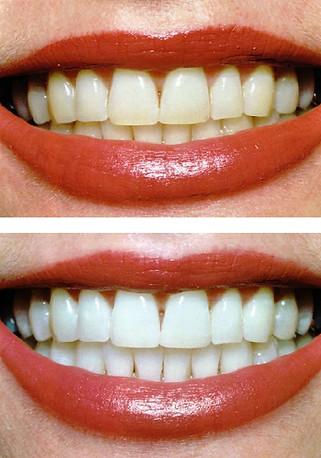 Teeth Whitening