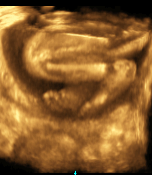 3d 4d Ultrasound Packages Belladonnamidwifery