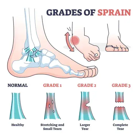 ligament sprain