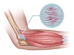 Tendinitis 101: Understanding Tendinopathies and Their Differences