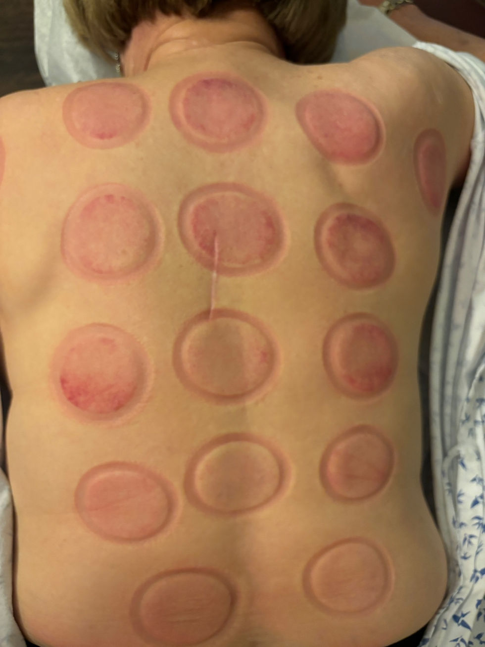 cupping for pain relief