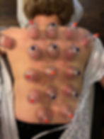 Cupping therapy