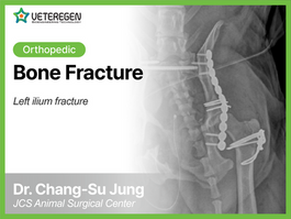 Bone Fracture
