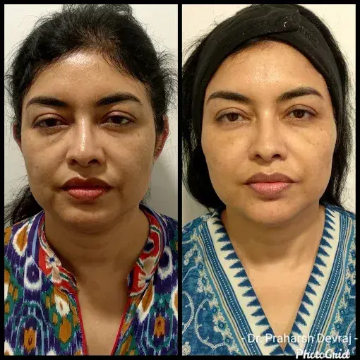 1 dark circles removal in sadashivanagar  before after