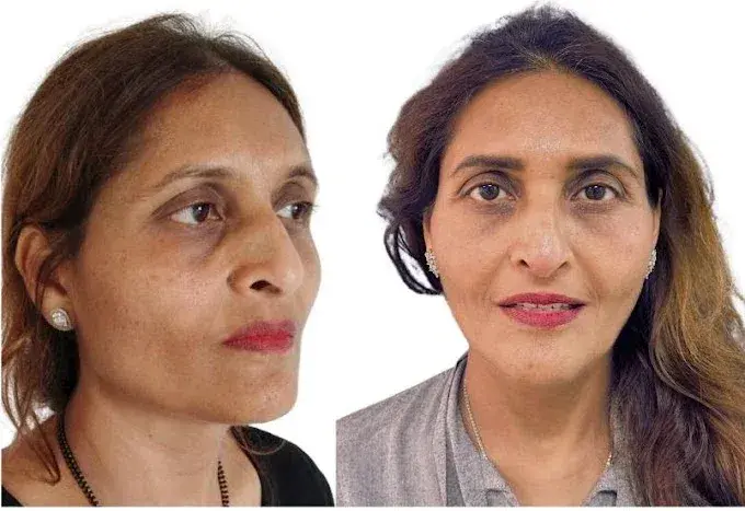 1 clinic for dark circles removal sadashivanagar 