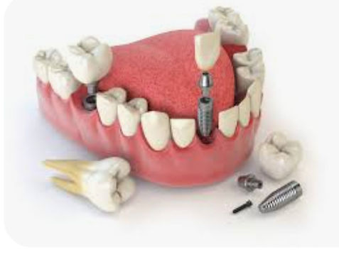 השתלת שיניים.jpeg