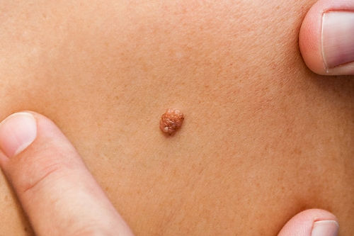 Mole Removal Kit