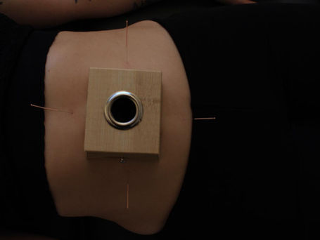 Acupuncture et digestion