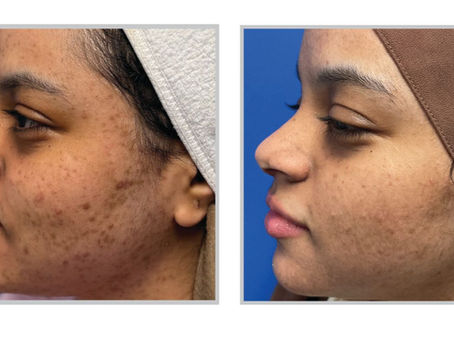 halo laser B&A