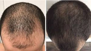 PEpFactor Scalp Vatan.jpeg