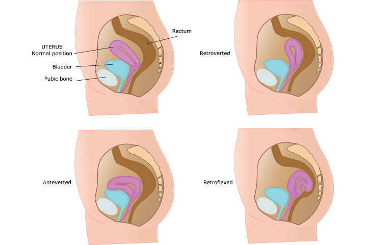 Uterus positions