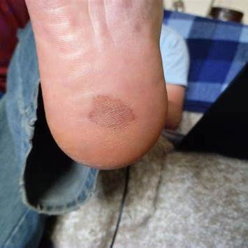 Stone Bruises: Acının Derinlerine Bir Bakış