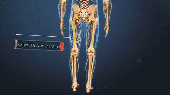 sciatica pain