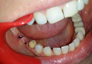 Edentație (lipsa dinților) pe partea dreaptă inferior, rezolvată cu implante și punte dentară cerami