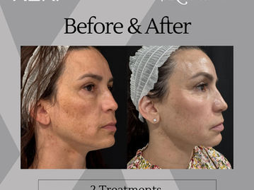 Why Combination Treatments Are the Future of Aesthetic Rejuvenation: XERF + More