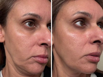 The New Standard of Skin Tightening: Why XERF Is Changing the Way We Age