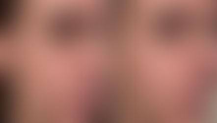 The New Standard of Skin Tightening: Why XERF Is Changing the Way We Age