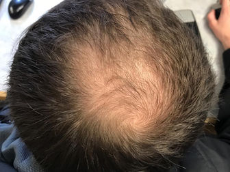 Signalling molecule moves hair follicle niche fibroblasts to a hyper-activated state